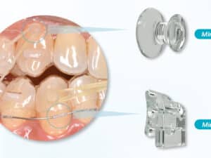 MiniTubo MiniBotón MiniHook